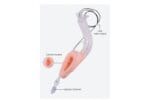 Camjoy VM101 Video Laryngeal Mask detail image 1